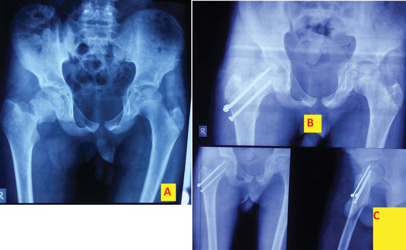 Anteroposterior view of a 13-year-old boy with type II fracture (A). Postoperative radiograph showing fixation with a screw and two pins (B). Final radiograph at 1 year showing union (C).